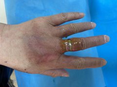 手指烫伤后浮肿严重戒指难摘 大妈辗转多家医院求治疗