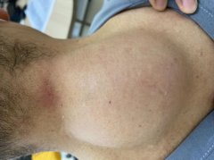 把“脂肪瘤”当“富贵包” 老汉后颈疼痛难忍